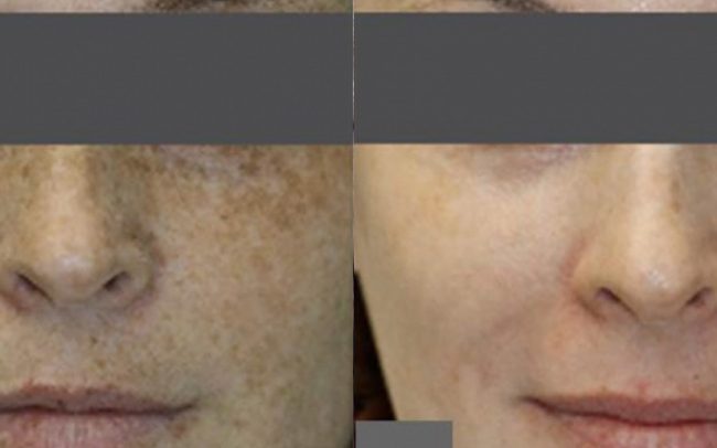 Laser Skin Rejuvenation