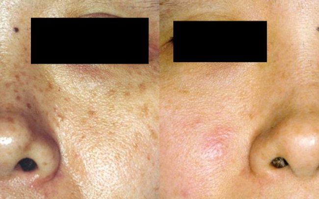 Pigmentation Removal