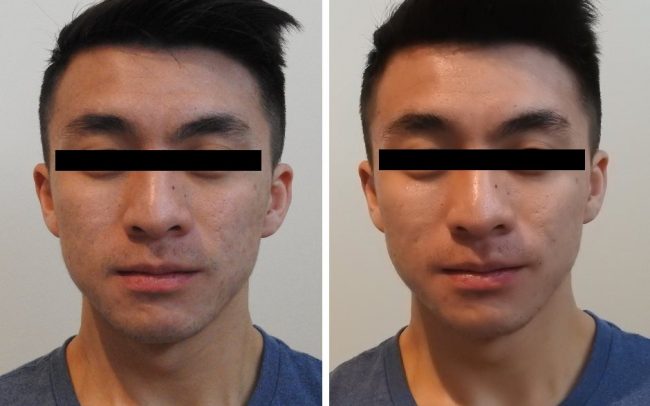 hydrafacial sydney review by N V